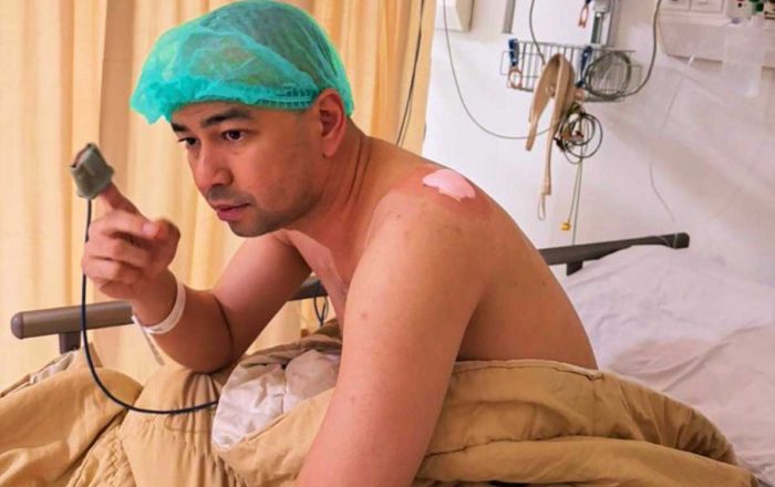 Raffi Ahmad Jalani Operasi Bahu, Benjolan 6 Cm Diduga Lipoma Jadi Sorotan